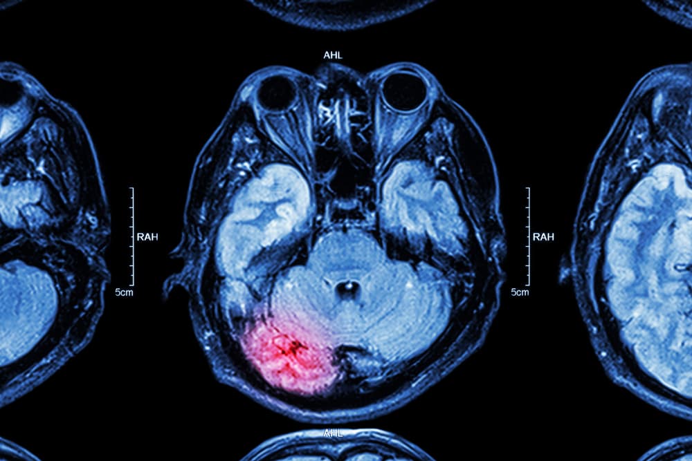 MRI of brain